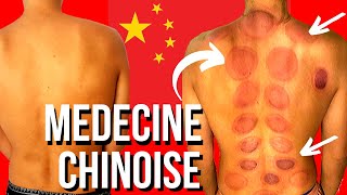 Je teste la médecine traditionnelle Chinoise : la cupping thérapie (et ça fait mal) 😳